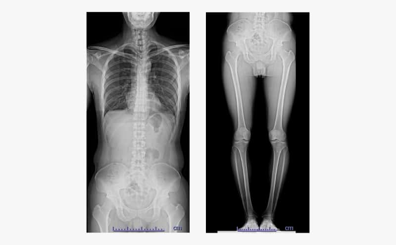 Ｘ線透視装置で撮影された写真